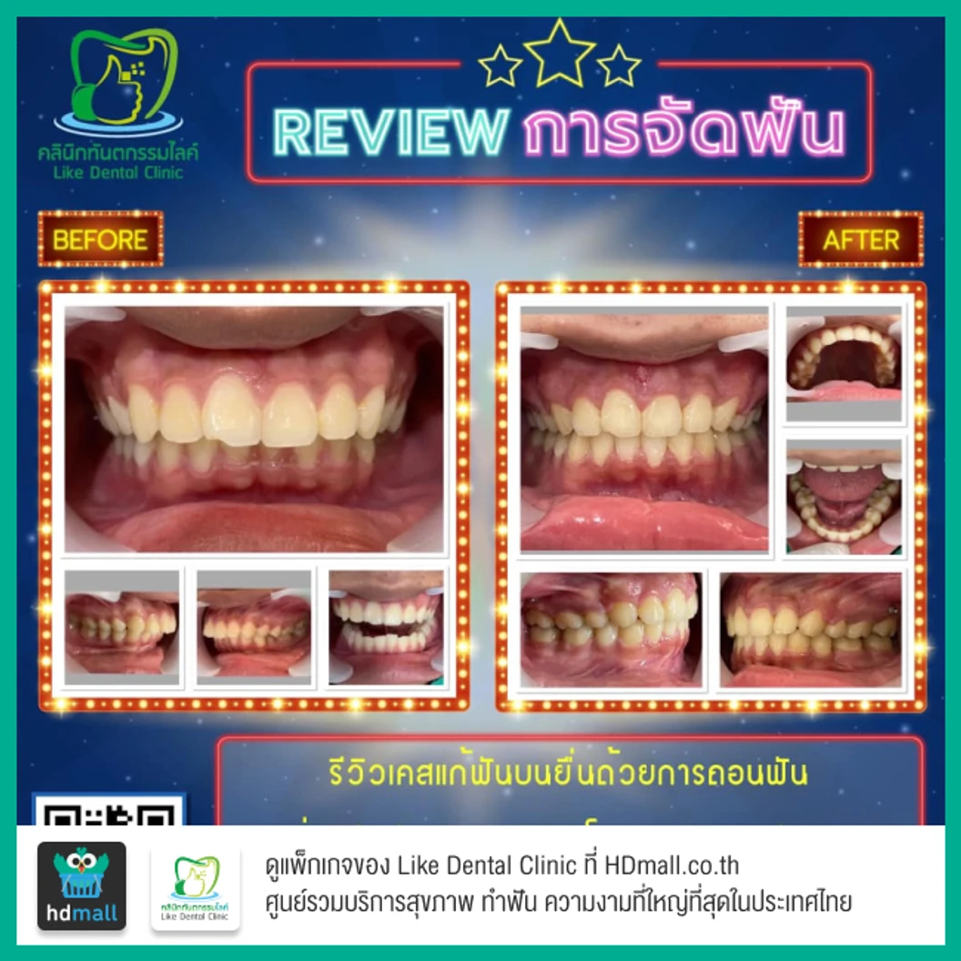 จัดฟัน Damon Q ฟันบนและล่าง