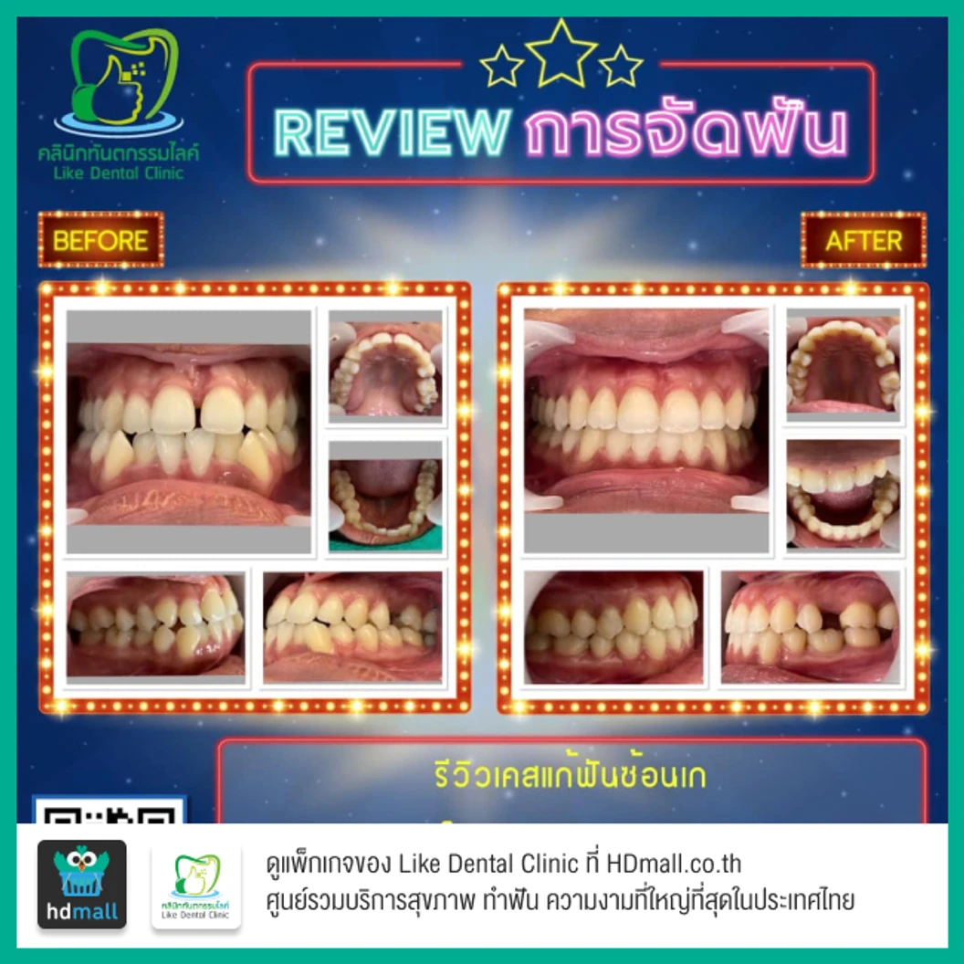 จัดฟัน Damon Q ฟันบนและล่าง