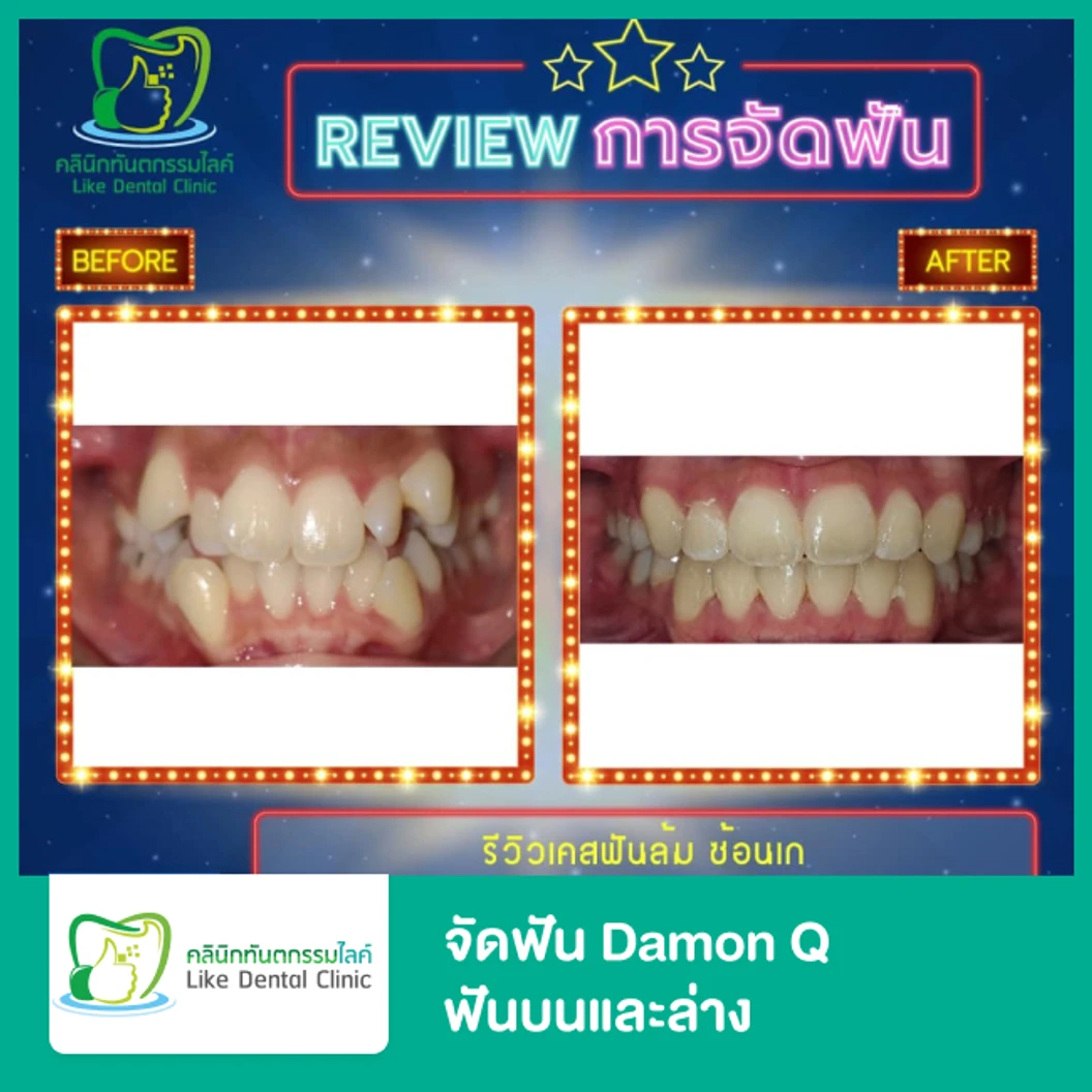 จัดฟัน Damon Q ฟันบนและล่าง