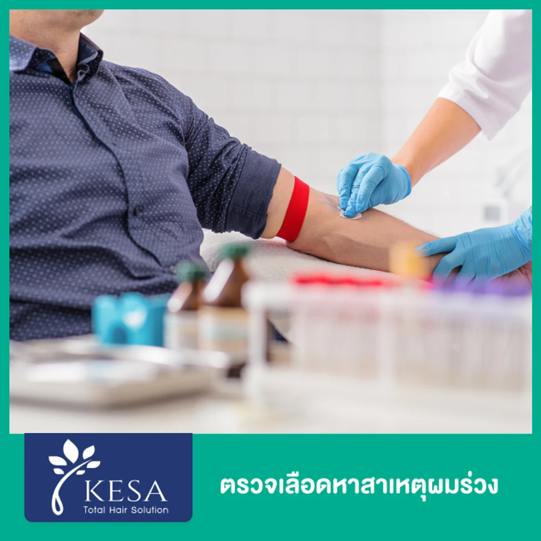 ตรวจเลือดหาสาเหตุผมร่วง