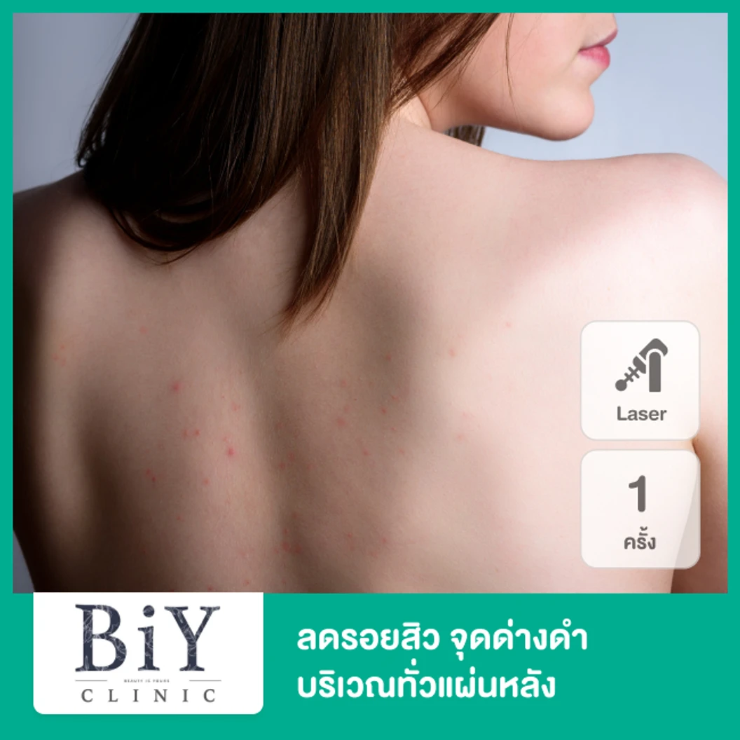 ลดรอยสิว จุดด่างดำ ด้วย SHR Machine บริเวณทั่วแผ่นหลัง 1 ครั้ง