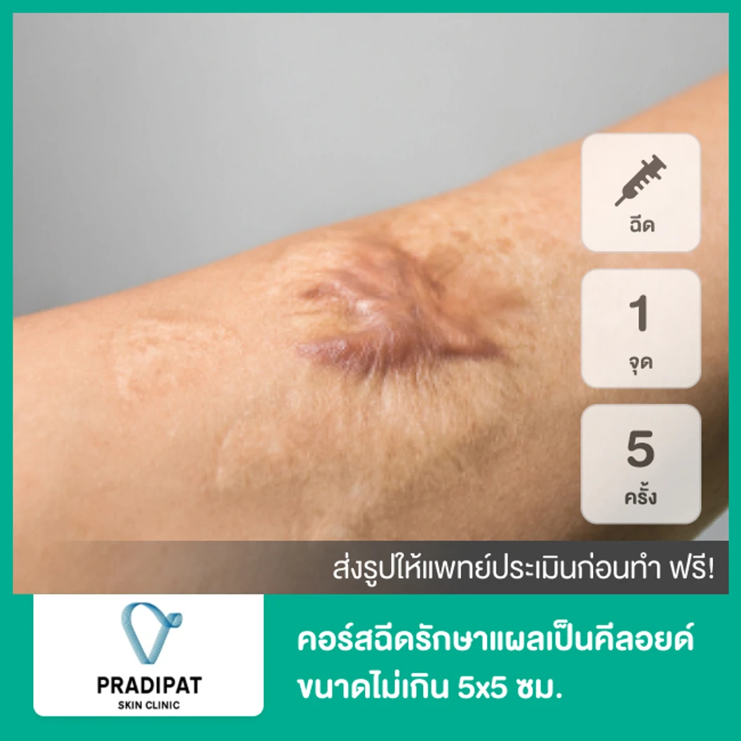 คอร์สฉีดรักษาแผลเป็นคีลอยด์ ขนาดเส้นผ่านศูนย์กลางไม่เกิน 5x5 ซม. 1 จุด 5 ครั้ง
