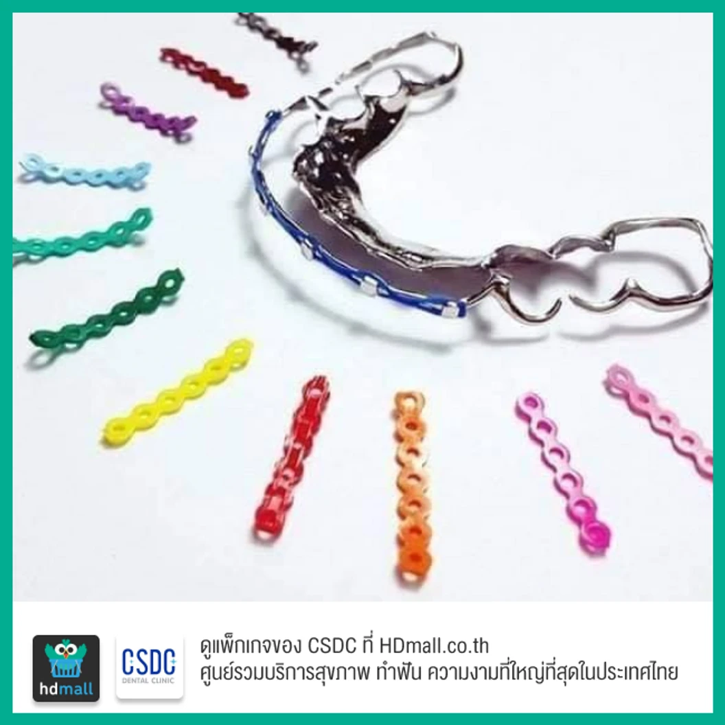 ทำรีเทนเนอร์แบบโลหะ (มีเชน) 2 ชิ้น ฟันบนและล่าง