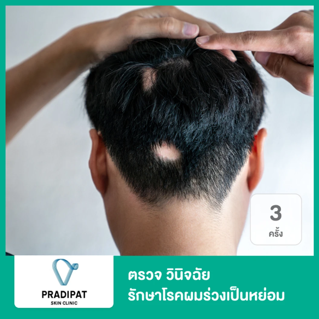 ตรวจ วินิจฉัย รักษาโรคผมร่วงเป็นหย่อม 3 ครั้ง