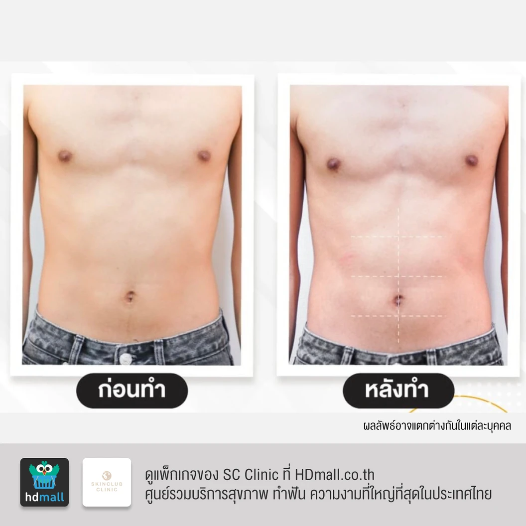 คอร์สสร้างกล้ามเนื้อ สลายไขมัน ด้วย HIFEM บริเวณหน้าท้อง 15 ครั้ง ภายใน 1 เดือน