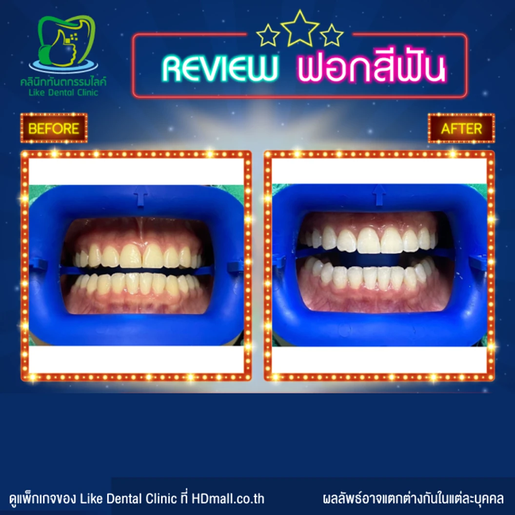 ฟอกสีฟัน ด้วยระบบ Cool Light