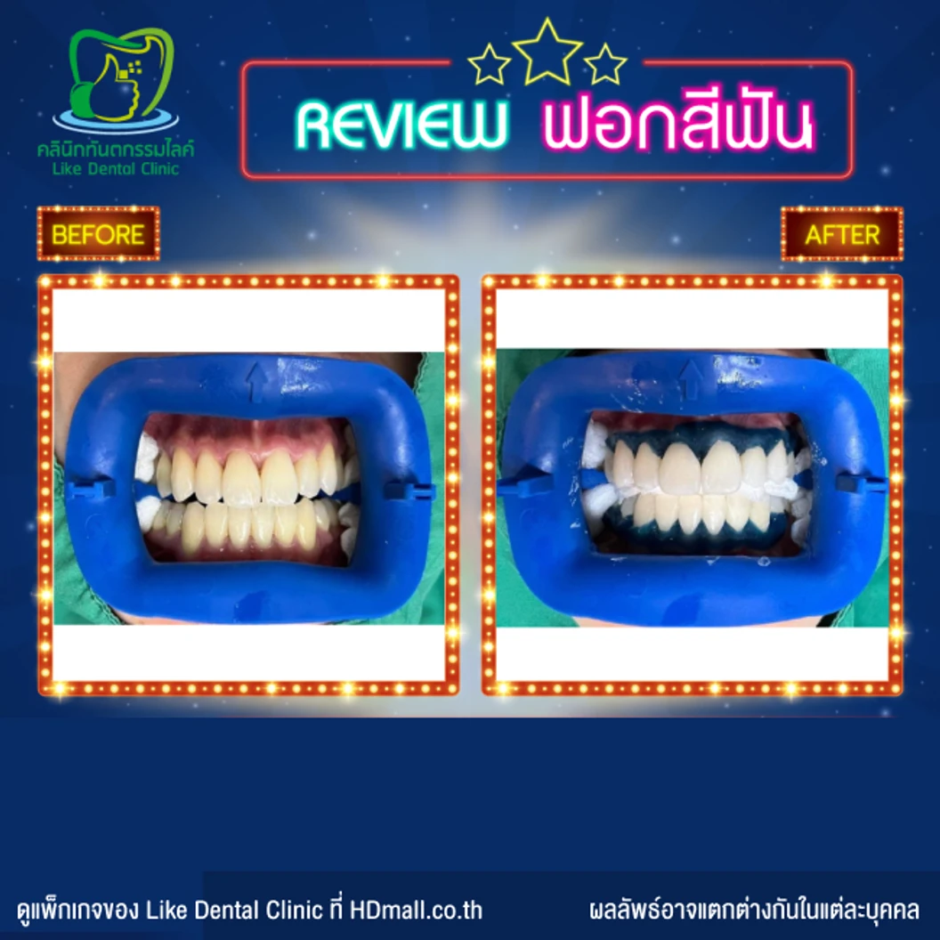 ฟอกสีฟัน ด้วยระบบ Cool Light