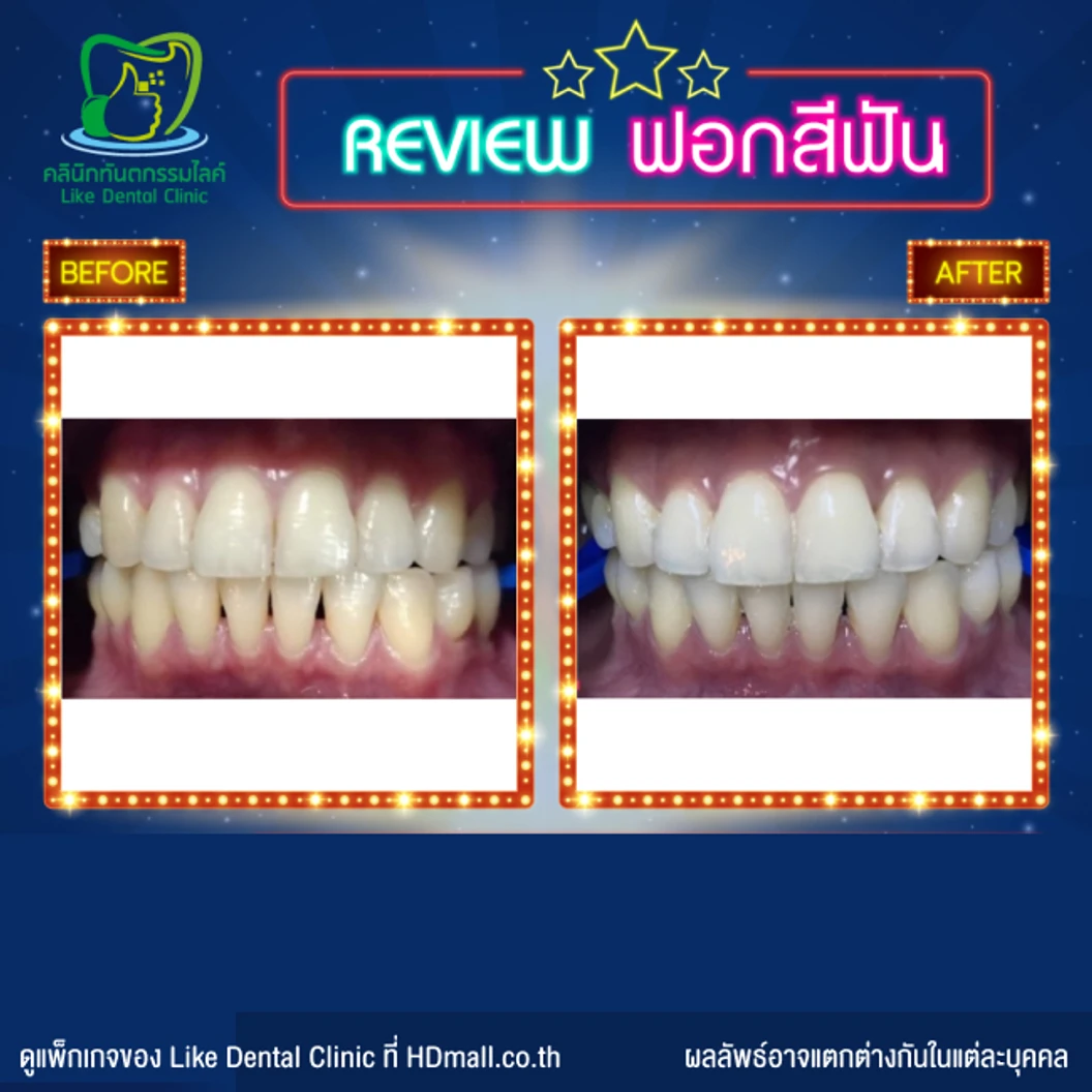 ฟอกสีฟัน ด้วยระบบ Cool Light