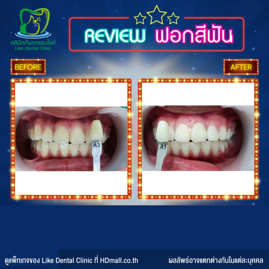ฟอกสีฟัน ด้วยระบบ Cool Light