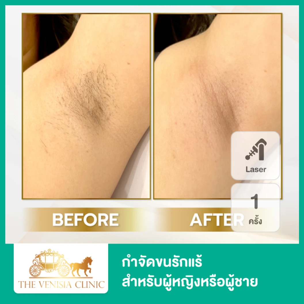 เลเซอร์ Mediostar กำจัดขนรักแร้ 1 ครั้ง