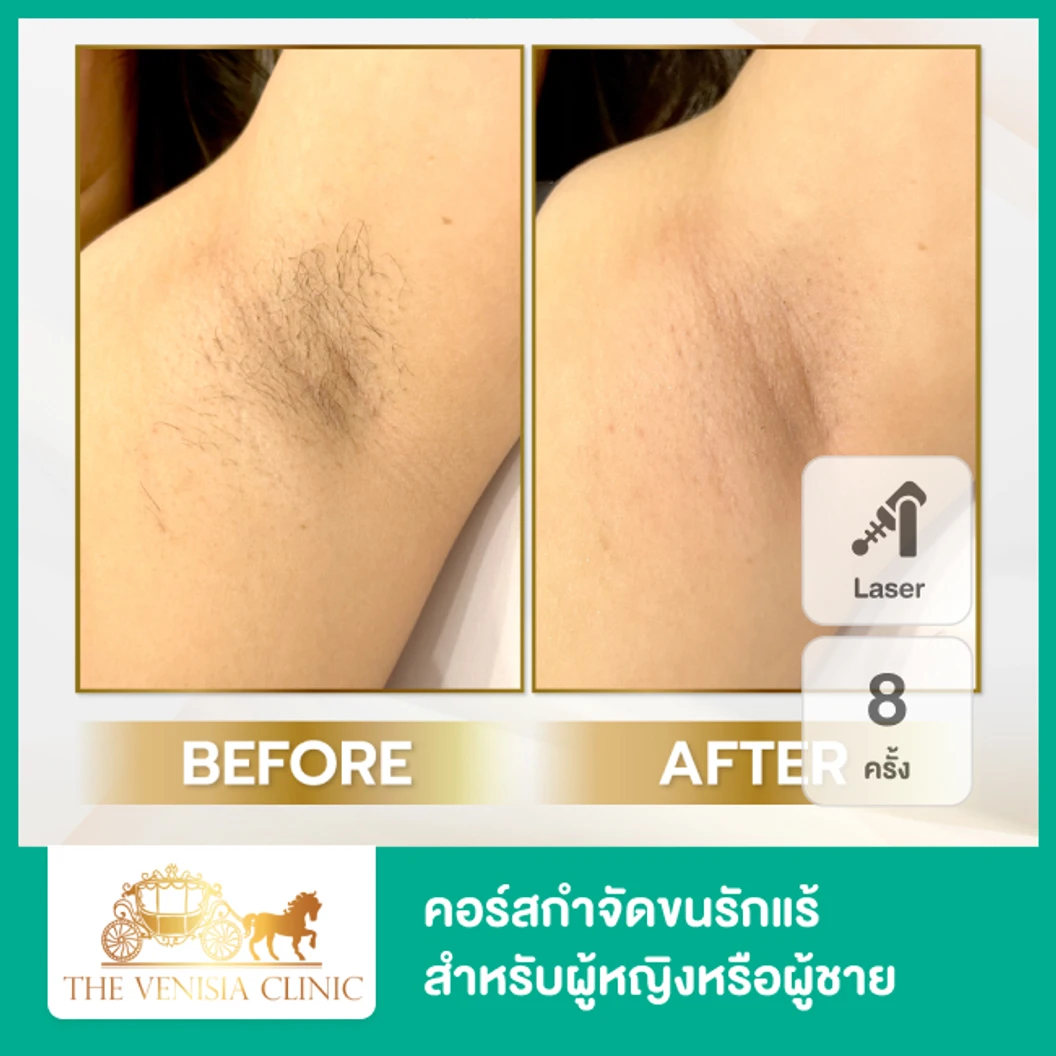 คอร์สเลเซอร์ Mediostar กำจัดขนรักแร้ 8 ครั้ง