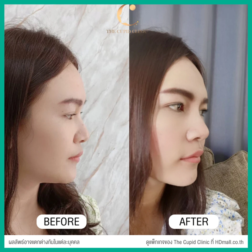 เสริมจมูก ด้วยซิลิโคนอเมริกาพรีเมียมแบบนิ่มบิดได้ เทคนิค Semi-Open สำหรับเคสแก้