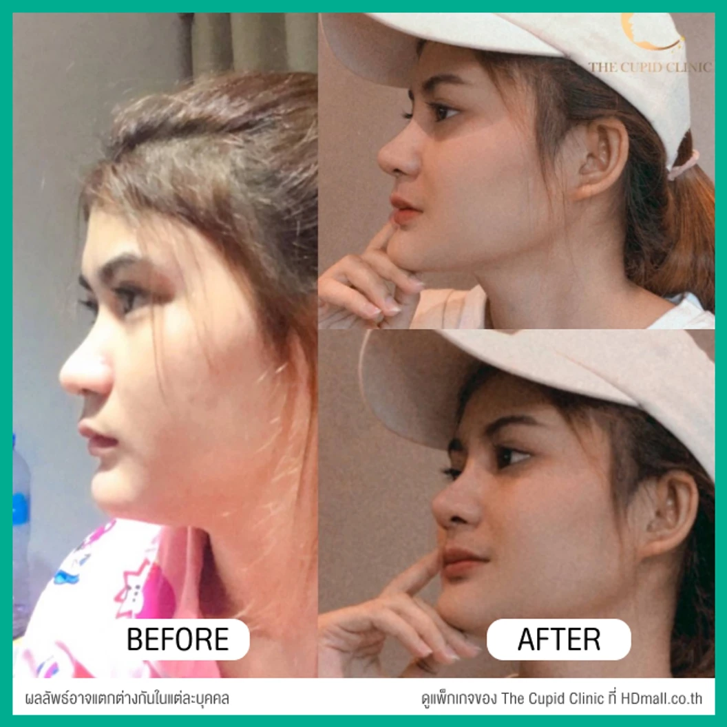 เสริมจมูก ด้วยซิลิโคนอเมริกาพรีเมียมแบบนิ่มบิดได้ เทคนิค Semi-Open สำหรับเคสแก้