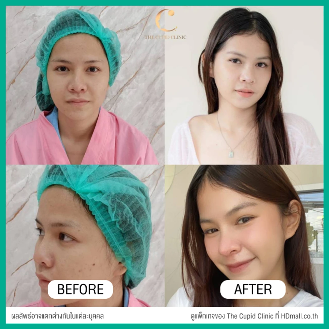 เสริมจมูก ด้วยซิลิโคนอเมริกาพรีเมียมแบบนิ่มบิดได้ เทคนิค Semi-Open สำหรับเคสแก้