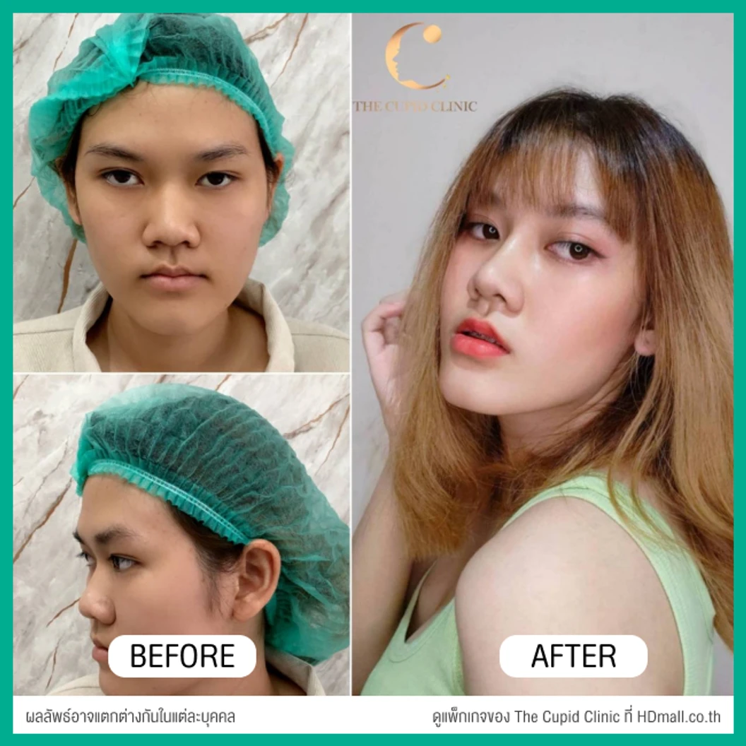 เสริมจมูก ด้วยซิลิโคนอเมริกาพรีเมียมแบบนิ่มบิดได้ เทคนิค Semi-Open สำหรับเคสแก้