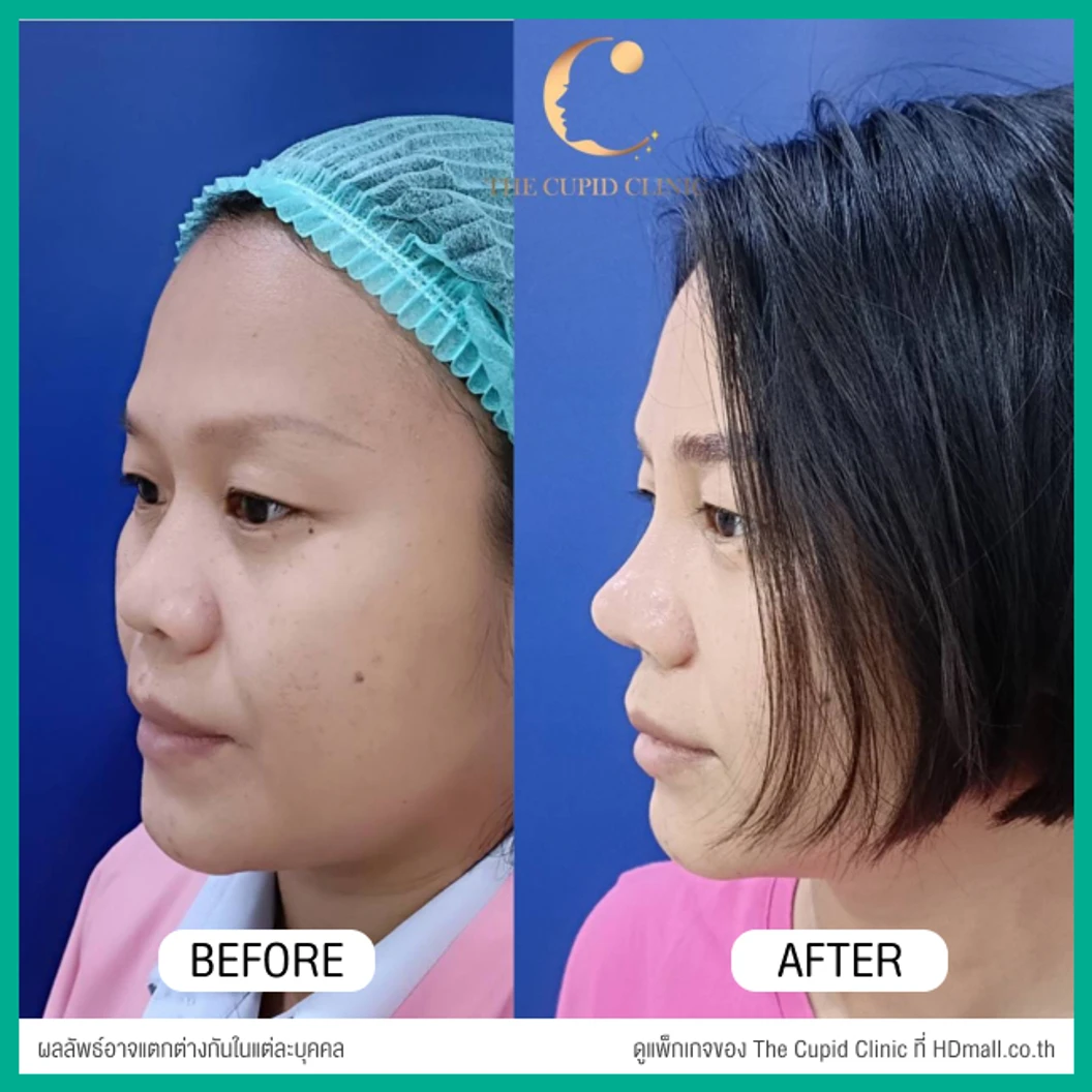 เสริมจมูก ด้วยซิลิโคนอเมริกาพรีเมียมแบบนิ่มบิดได้ เทคนิค Semi-Open สำหรับเคสแก้