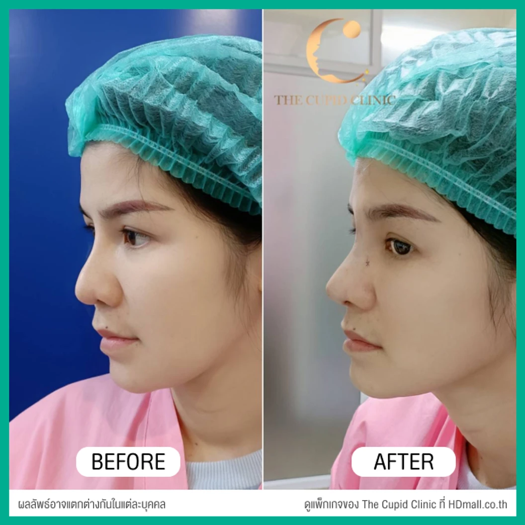 เสริมจมูก ด้วยซิลิโคนอเมริกาพรีเมียมแบบนิ่มบิดได้ เทคนิค Semi-Open สำหรับเคสแก้