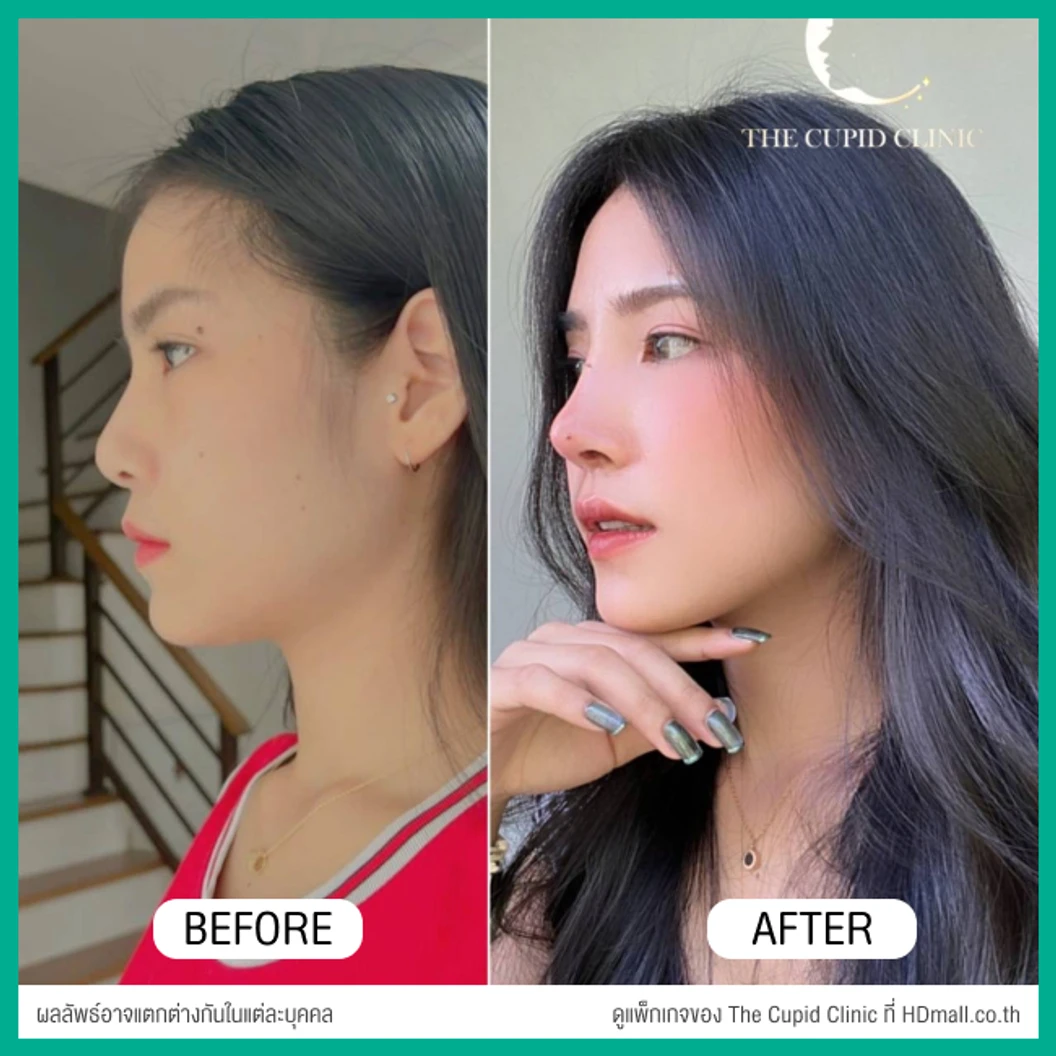 เสริมจมูก ด้วยซิลิโคนอเมริกาพรีเมียมแบบนิ่มบิดได้ เทคนิค Semi-Open สำหรับเคสแก้