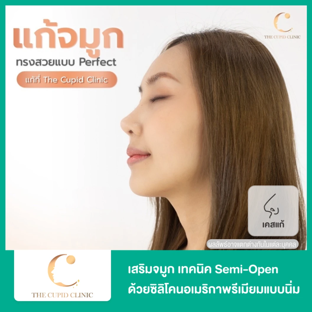 เสริมจมูก ด้วยซิลิโคนอเมริกาพรีเมียมแบบนิ่มบิดได้ เทคนิค Semi-Open สำหรับเคสแก้