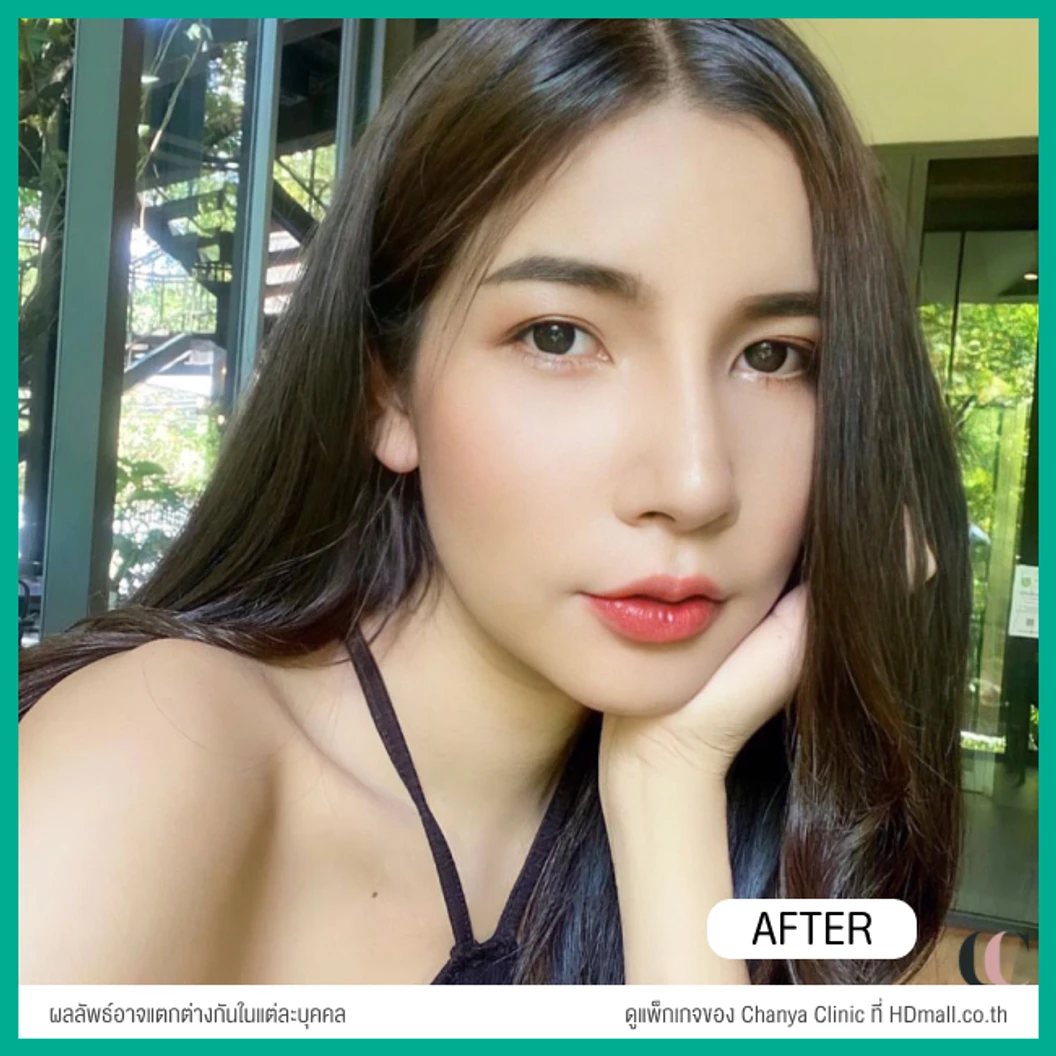 ทำปากกระจับ ริมฝีปากบน เทคนิค Distraction Technique With GCT สำหรับเคสแก้ เฉพาะเคสรีวิวเท่านั้น