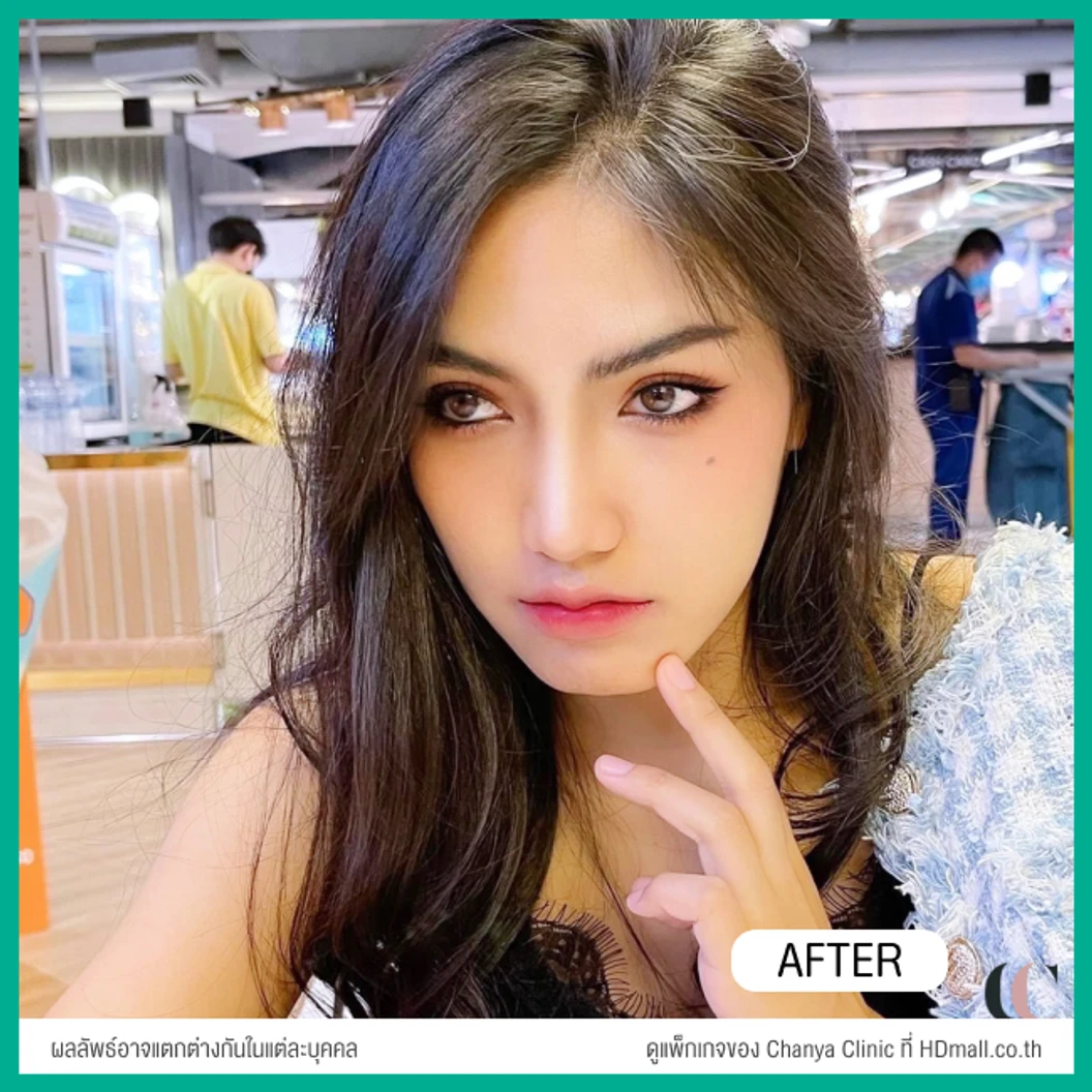 ทำปากกระจับ ริมฝีปากบน เทคนิค Distraction Technique With GCT สำหรับเคสแก้ เฉพาะเคสรีวิวเท่านั้น