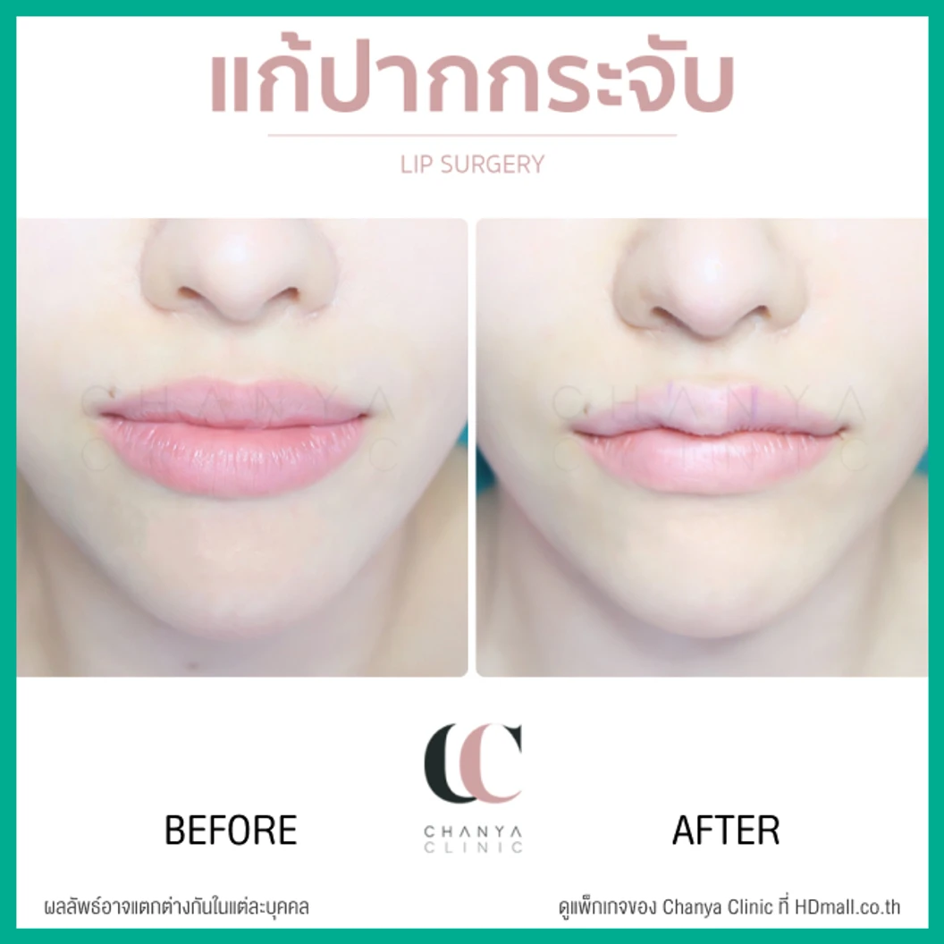 ทำปากกระจับ ริมฝีปากบน เทคนิค Distraction Technique With GCT สำหรับเคสแก้ เฉพาะเคสรีวิวเท่านั้น