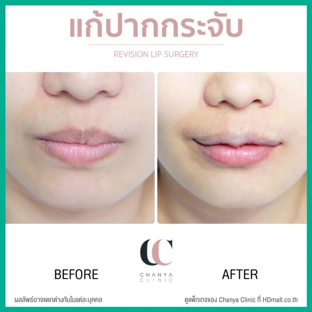 ทำปากกระจับ ริมฝีปากบน เทคนิค Distraction Technique With GCT สำหรับเคสแก้ เฉพาะเคสรีวิวเท่านั้น