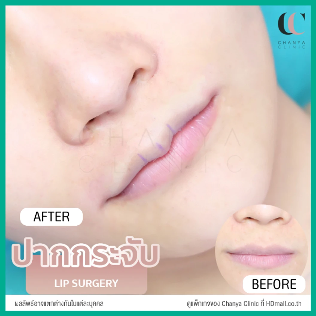 ทำปากกระจับ ริมฝีปากบน เทคนิค Distraction Technique With GCT สำหรับเคสแก้