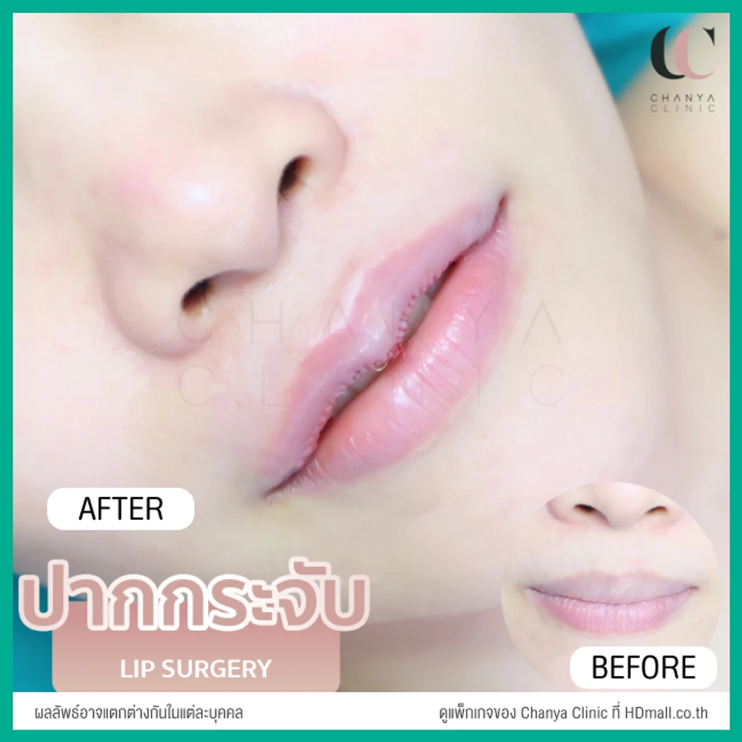 ทำปากกระจับ ริมฝีปากบน เทคนิค Distraction Technique With GCT สำหรับเคสแก้