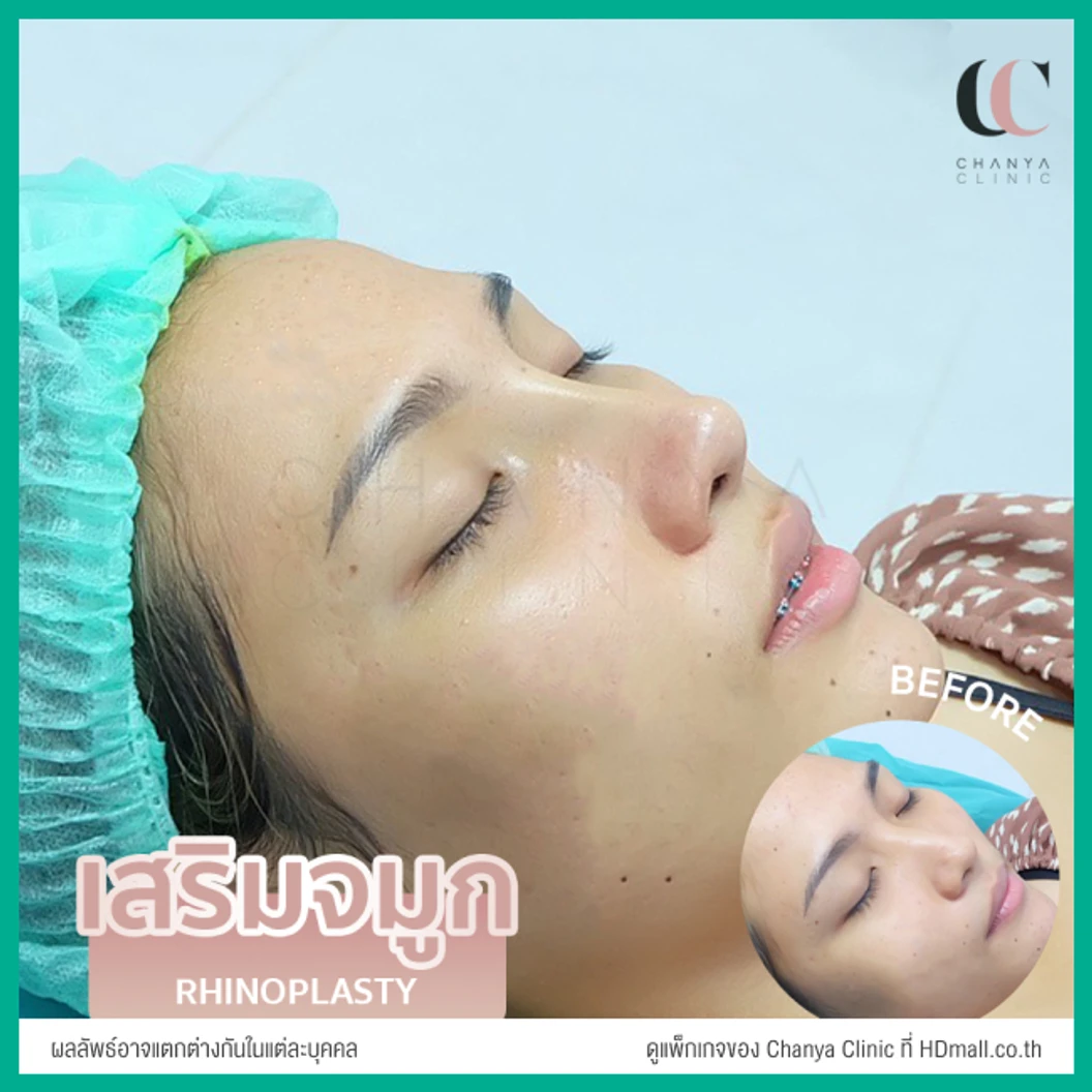 เสริมจมูก ด้วยซิลิโคนเกาหลี เทคนิค Semi Open สำหรับเคสรีวิวเท่านั้น