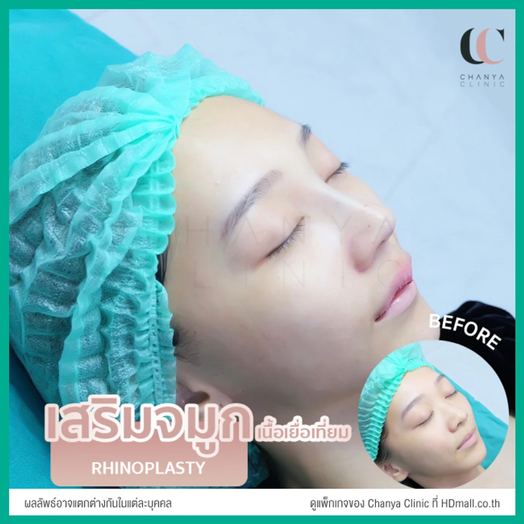 เสริมจมูก ด้วยซิลิโคนเกาหลี เทคนิค Semi Open สำหรับเคสรีวิวเท่านั้น