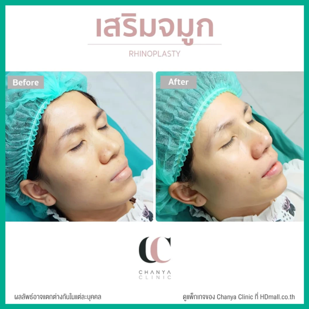 เสริมจมูก ด้วยซิลิโคนเกาหลี เทคนิค Semi Open สำหรับเคสรีวิวเท่านั้น