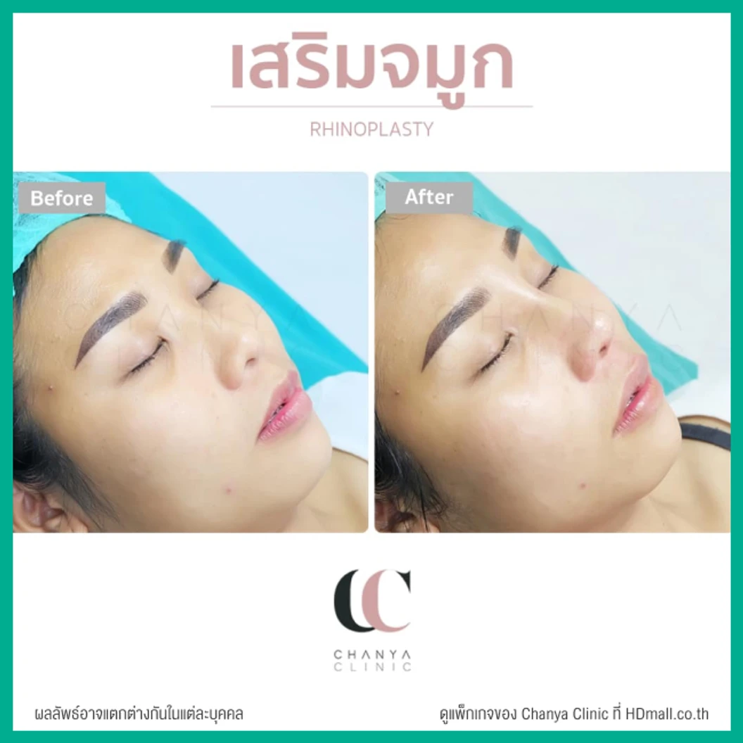 เสริมจมูก ด้วยซิลิโคนเกาหลี เทคนิค Semi Open สำหรับเคสรีวิวเท่านั้น