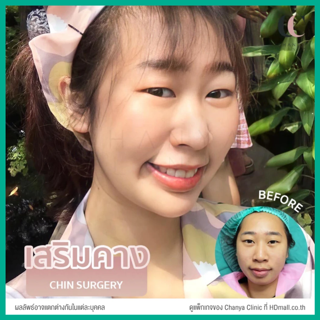 เสริมคาง ด้วยซิลิโคนเกาหลีขาสั้น เทคนิคเกาหลีแผลใน สำหรับเคสรีวิวเท่านั้น