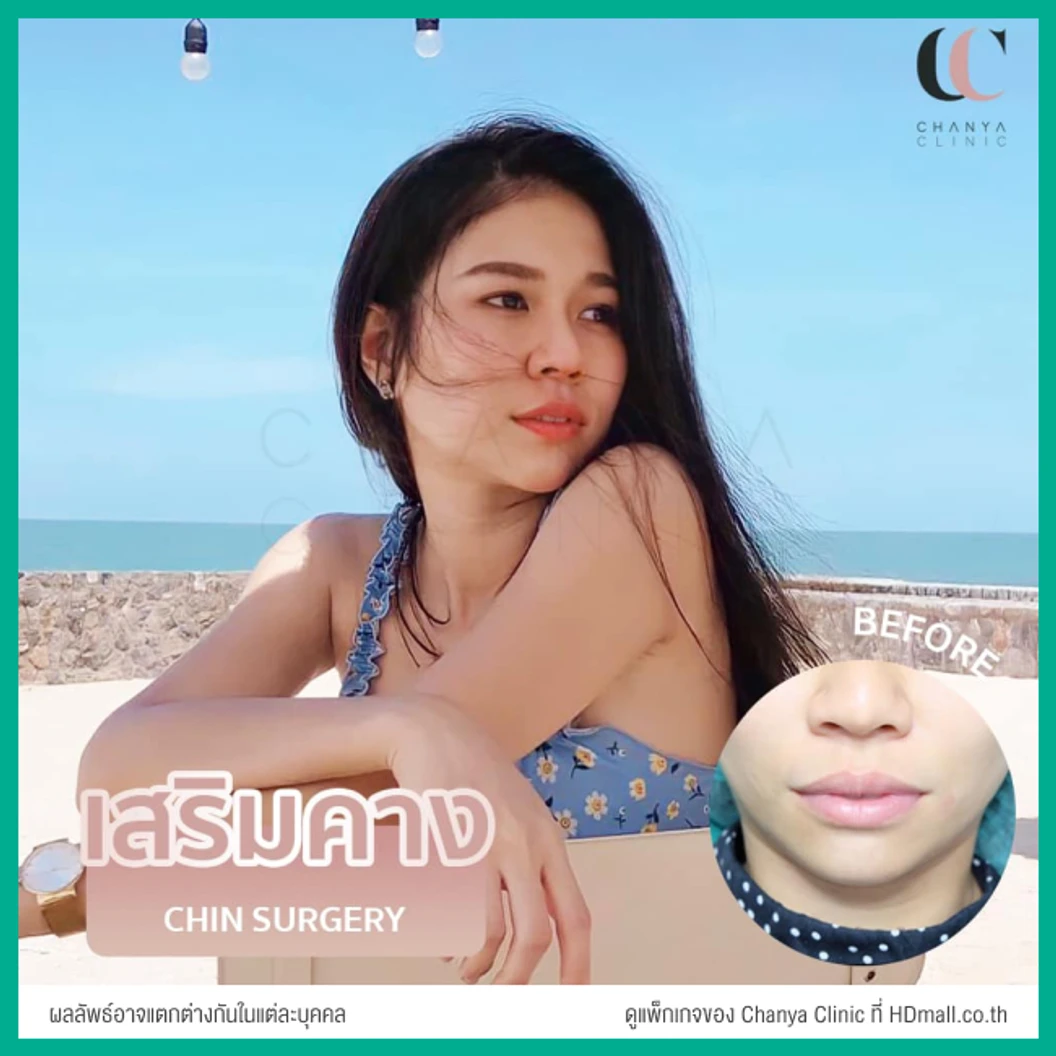 เสริมคาง ด้วยซิลิโคนเกาหลีขาสั้น เทคนิคเกาหลีแผลใน สำหรับเคสรีวิวเท่านั้น