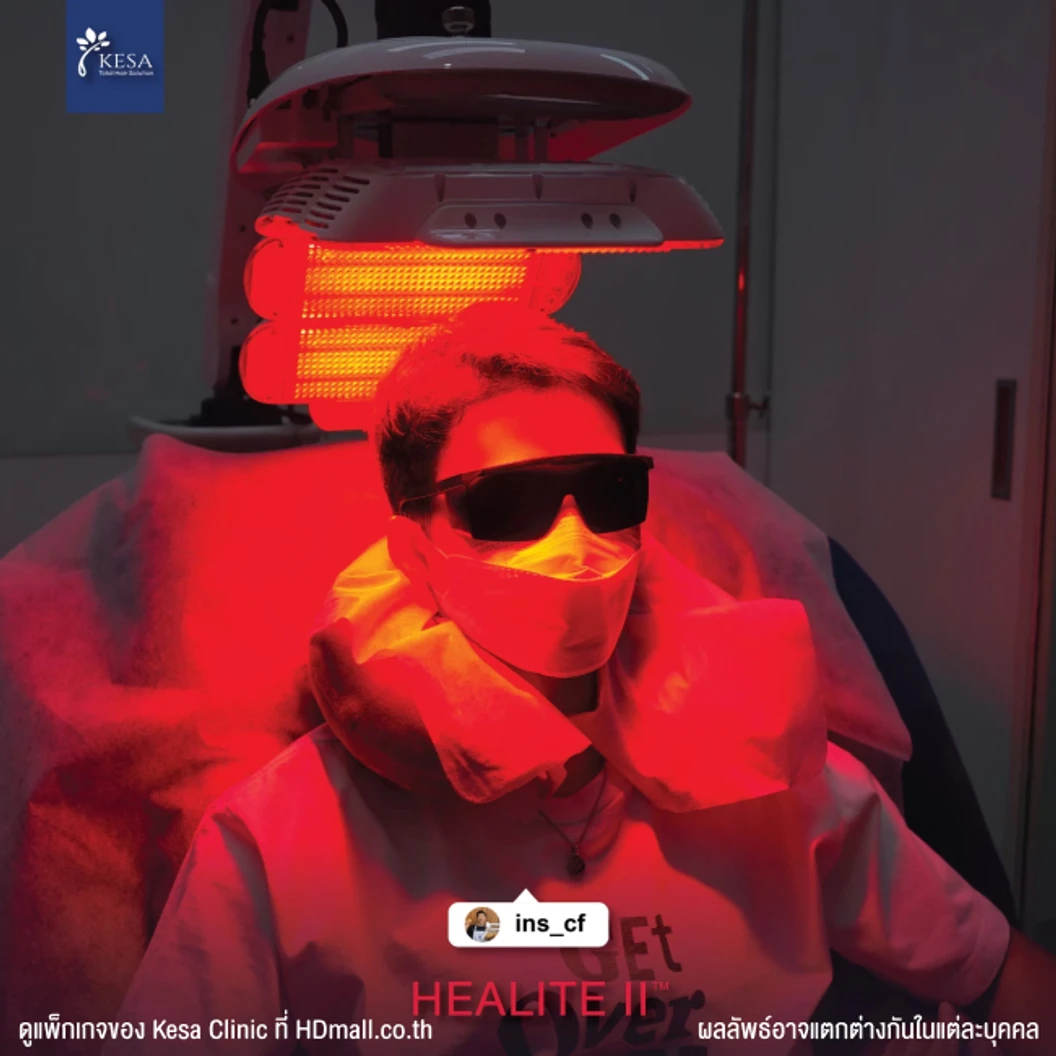 กระตุ้นรากผม กระตุ้นผมเกิดใหม่ ลดการขาดหลุดร่วง ด้วยเลเซอร์ HEALITE II เทคโนโลยี Low Level Laser Light Therapy (LLLT) 1 ครั้ง