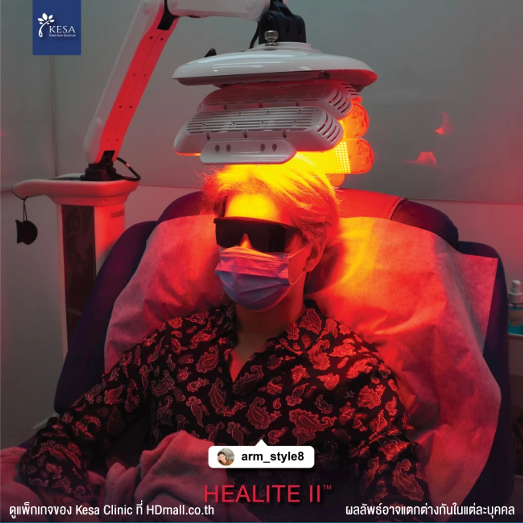 คอร์สกระตุ้นรากผม กระตุ้นผมเกิดใหม่ ลดการขาดหลุดร่วง ด้วยเลเซอร์ HEALITE II เทคโนโลยี Low Level Laser Light Therapy (LLLT) 6 ครั้ง