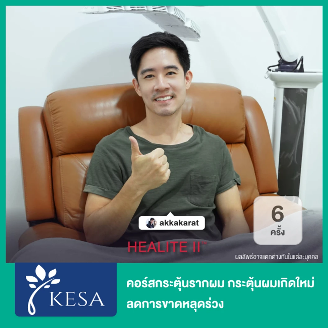 คอร์สกระตุ้นรากผม กระตุ้นผมเกิดใหม่ ลดการขาดหลุดร่วง ด้วยเลเซอร์ HEALITE II เทคโนโลยี Low Level Laser Light Therapy (LLLT) 6 ครั้ง