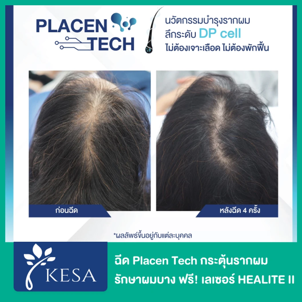 ฉีด Placen Tech กระตุ้นรากผม รักษาผมบาง 1 ครั้ง ฟรี! เลเซอร์ HEALITE II กระตุ้นรากผม 1 ครั้ง
