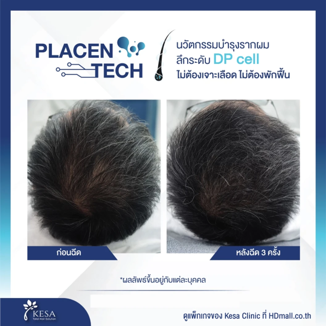 คอร์สฉีด Placen Tech กระตุ้นรากผม รักษาผมบาง 6 ครั้ง ฟรี! เลเซอร์ HEALITE II กระตุ้นรากผม 6 ครั้ง