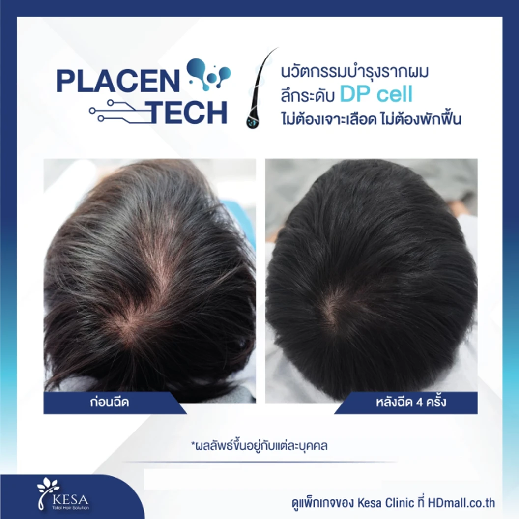 คอร์สฉีด Placen Tech กระตุ้นรากผม รักษาผมบาง 6 ครั้ง ฟรี! เลเซอร์ HEALITE II กระตุ้นรากผม 6 ครั้ง