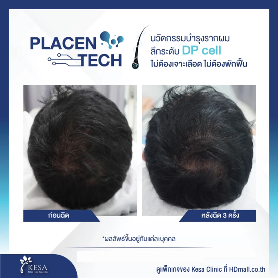 คอร์สฉีด Placen Tech กระตุ้นรากผม รักษาผมบาง 10 ครั้ง ฟรี! เลเซอร์ HEALITE II กระตุ้นรากผม 10 ครั้ง