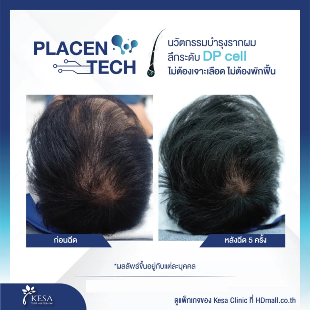 คอร์สฉีด Placen Tech กระตุ้นรากผม รักษาผมบาง 10 ครั้ง ฟรี! เลเซอร์ HEALITE II กระตุ้นรากผม 10 ครั้ง