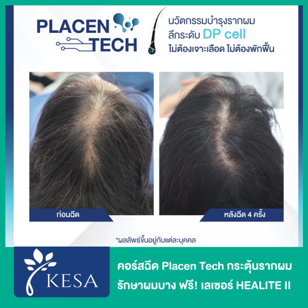 คอร์สฉีด Placen Tech กระตุ้นรากผม รักษาผมบาง 10 ครั้ง ฟรี! เลเซอร์ HEALITE II กระตุ้นรากผม 10 ครั้ง