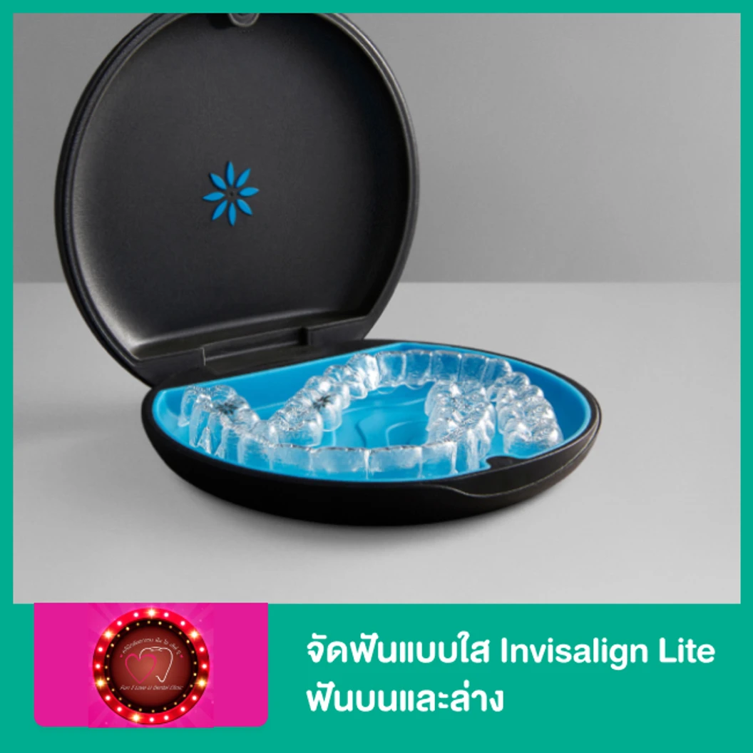 จัดฟันแบบใส Invisalign Lite ฟันบนและล่าง
