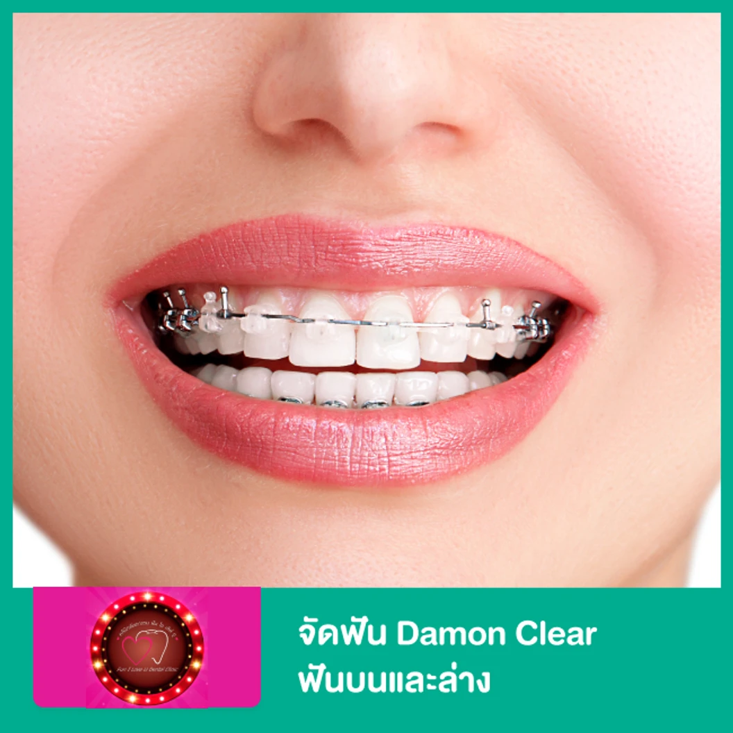 จัดฟัน Damon Clear ฟันบนและล่าง