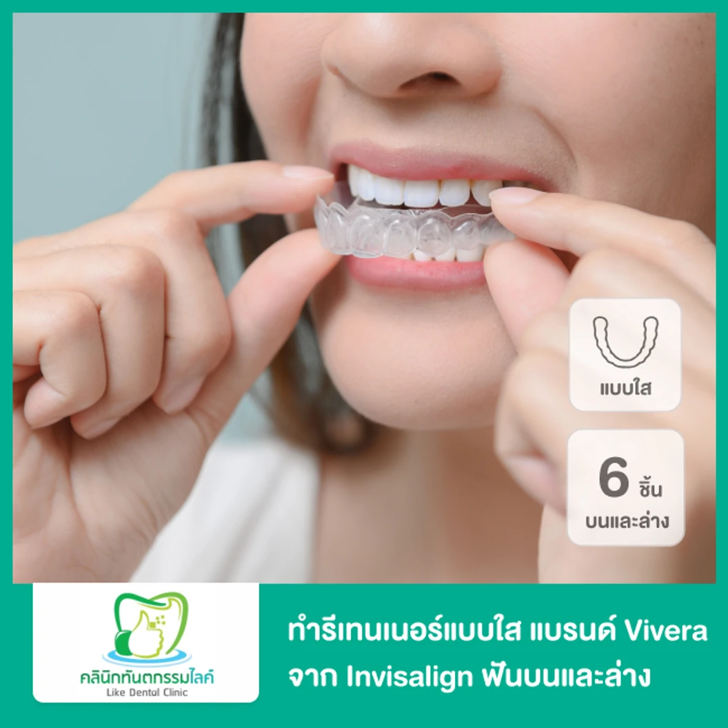 ทำรีเทนเนอร์แบบใส แบรนด์ Vivera จาก Invisalign ฟันบนและล่าง (3 คู่ 6 ชิ้นงาน)