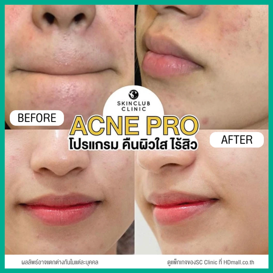 รักษาสิวทั่วใบหน้า 4 ขั้นตอน กดสิว ฉีดสิว มาส์ก และฉายแสง 1 ครั้ง