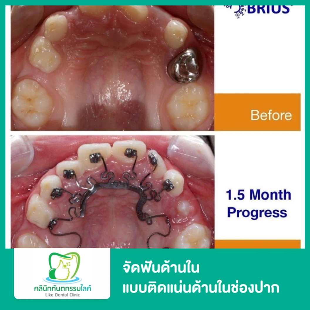 จัดฟันด้านใน แบบติดแน่นด้านในช่องปาก (Brava by Brius)