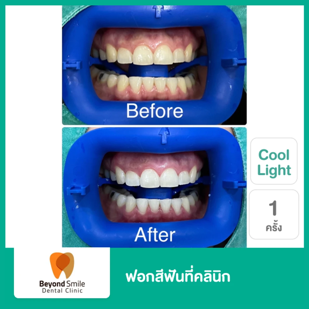 ฟอกสีฟันที่คลินิก ด้วยระบบ Cool Light 1 ครั้ง
